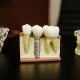 Dental Implants, Implants, Cost of Implants, What is Implants, What is the true cist of implants, How much is dental implants, How does Implants work