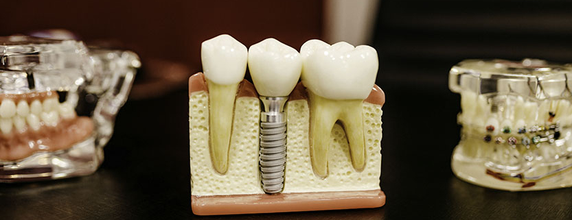 Dental Implants, Implants, Cost of Implants, What is Implants, What is the true cist of implants, How much is dental implants, How does Implants work