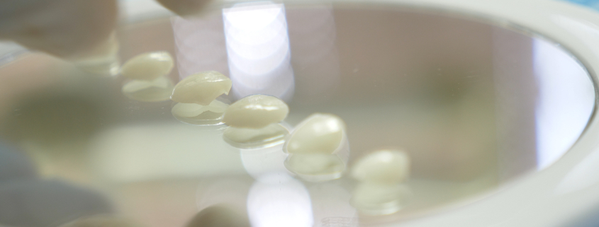dental veneers