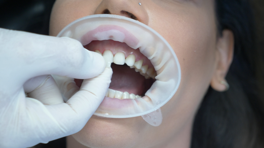 dental veneer candidate