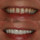 What are dental veneers