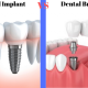 a dental implant vs a dental bridge