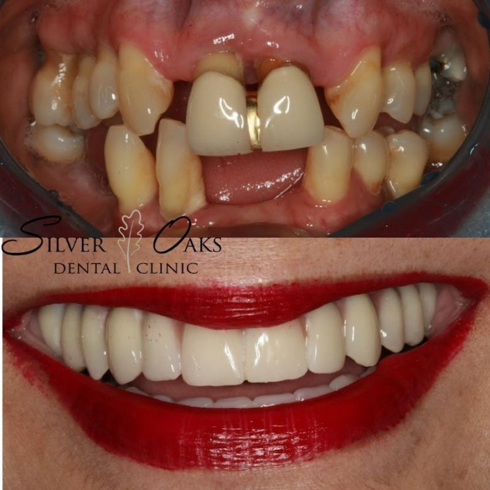 The Cost Of Dental Implants Silver Oaks Dental Clinic