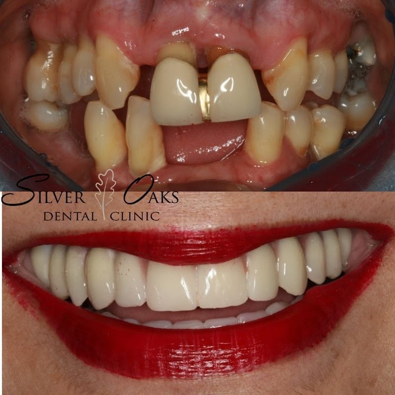 The Cost of Dental Implants in South Africa Silver Oaks Dental Clinic