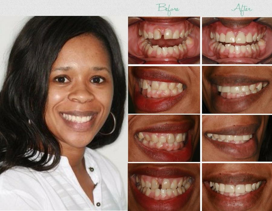 Cost Of Dental Crowns In South Africa at Gwendolyn Simon blog