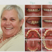 the cost of dental implants in south africa