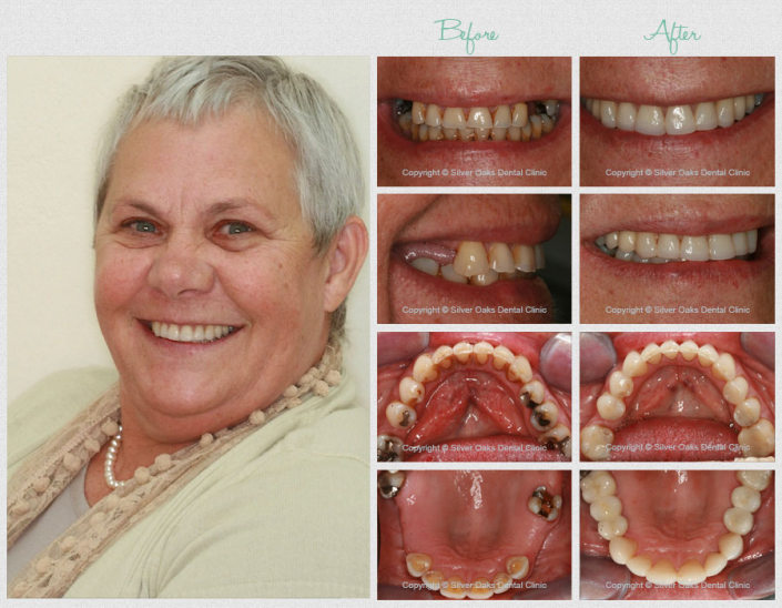 The Cost of Dental Implants in South Africa Silver Oaks Dental Clinic