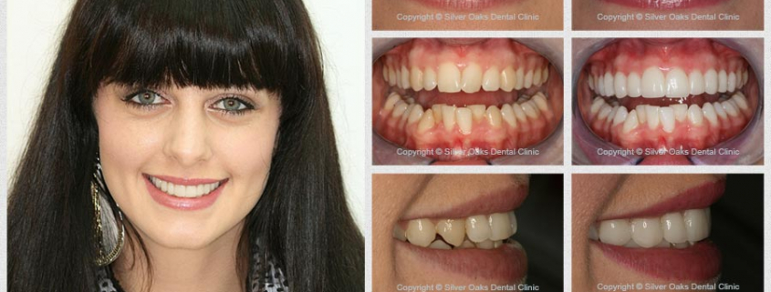 dental veneers pros and cons