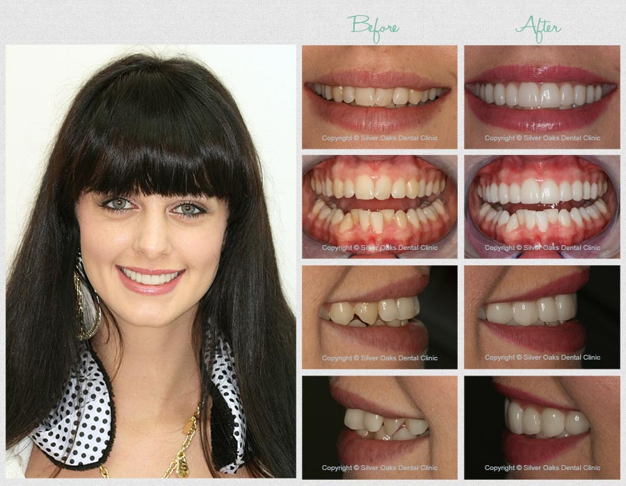 veneers